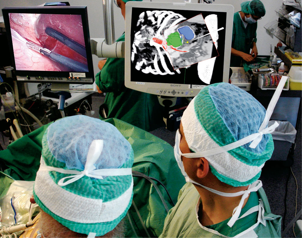 Bilde 2. Navigasjon i laparoskopisk kirurgi. 3D kartet med sporing og visual-isering av det kirurgiske instrumentet vises til høyre, ana-logt til GPS i bil (kartet er 3D CT bilder og bilen er instrumentet).